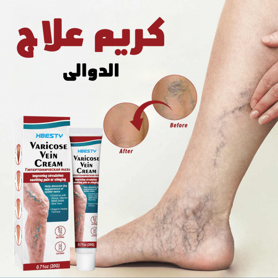 كريم علاج الدوالى