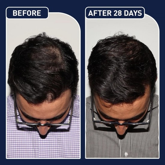 البخاخ الأمريكي لنمو الشعر FEG