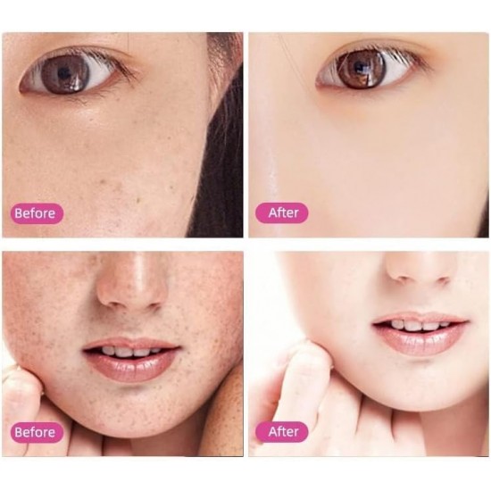 قلم ازالة الشامة بالبلازما